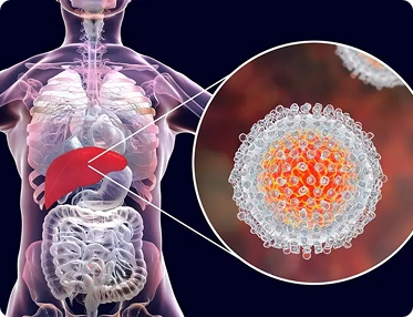 Liver infection