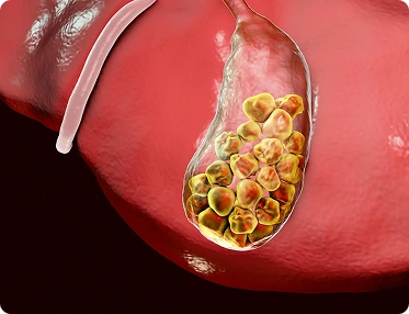 Gallstones