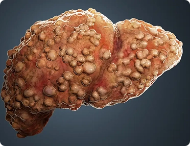 Liver cirrhosis