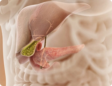 Bile duct blockage