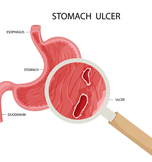 wht-are-Ulcer main