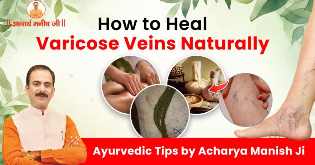 Ayurvedic-treatment-for-varicose-veins