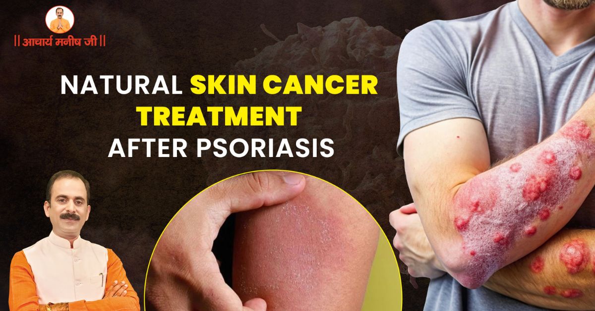 Skin Cancer Treatment After Psoriasis – Insights by Acharya Manish Ji