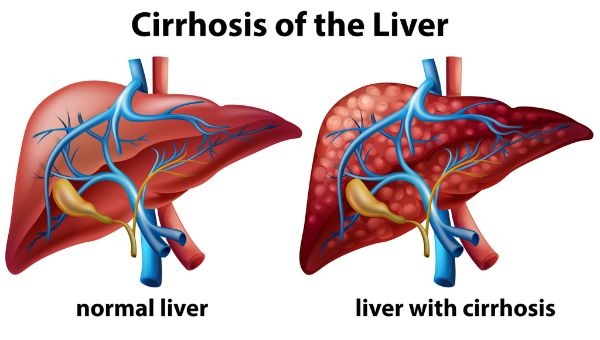 Liver Cirrhosis Treatment