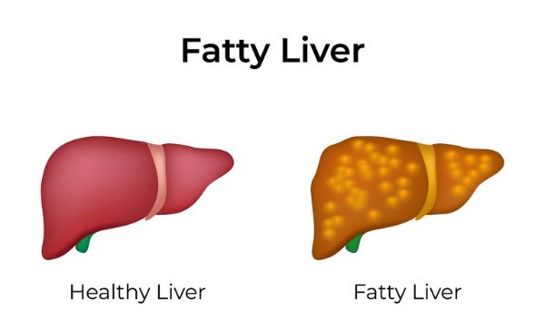 fatty liver