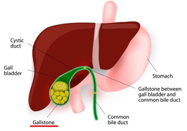 Gallbladder Stones