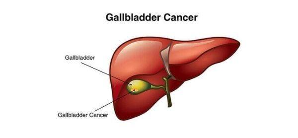 Gallbladder Cancer