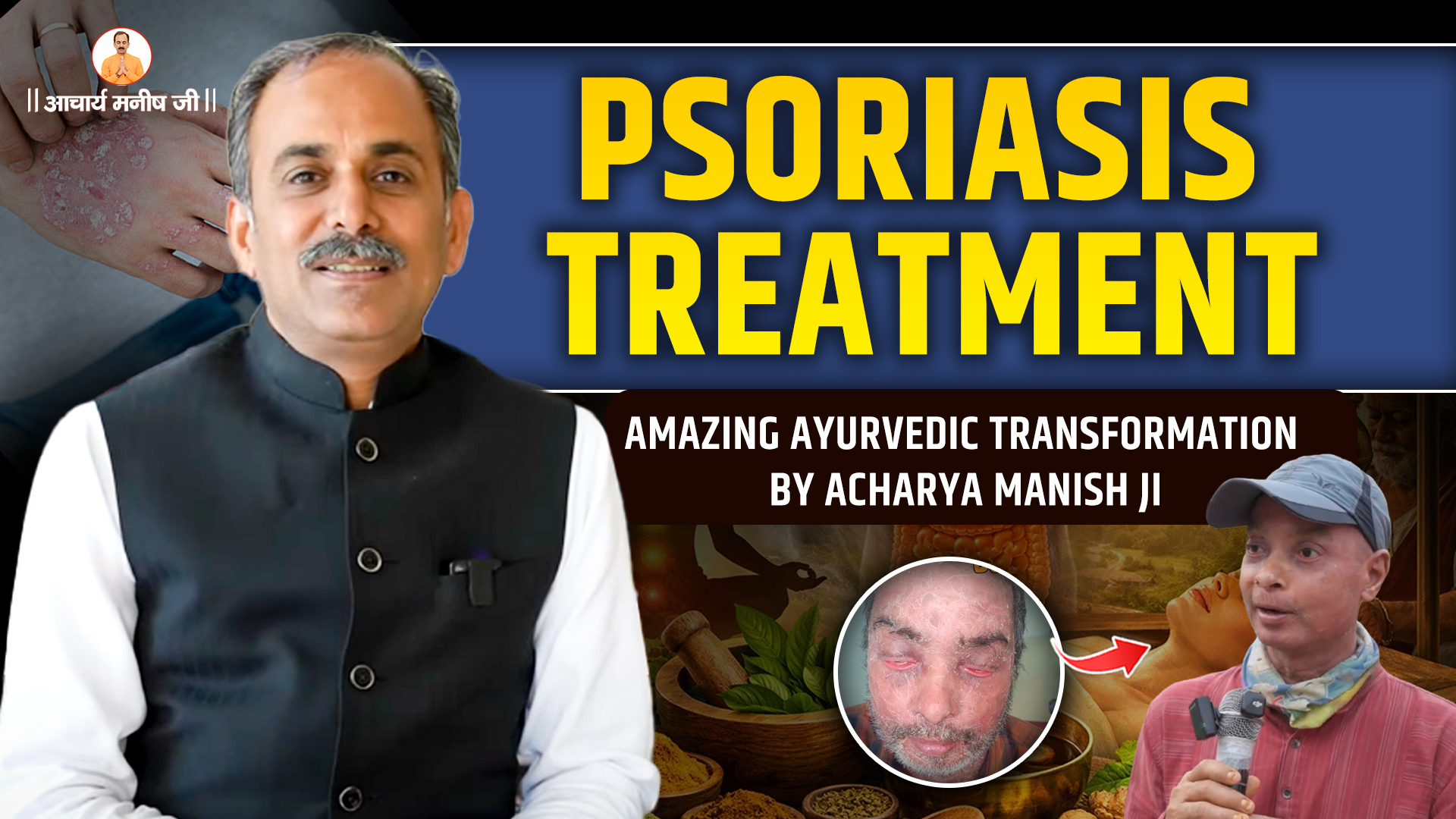 Psoriasis Treatment: Amazing Ayurvedic Transformation by Acharya Manish Ji