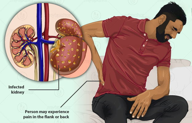 kidney-infection